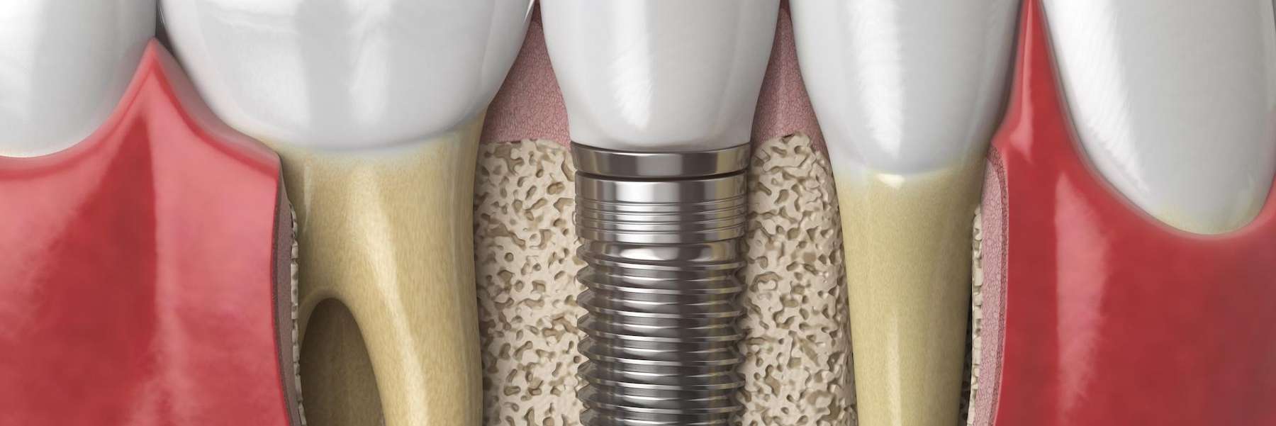 Dental Implant