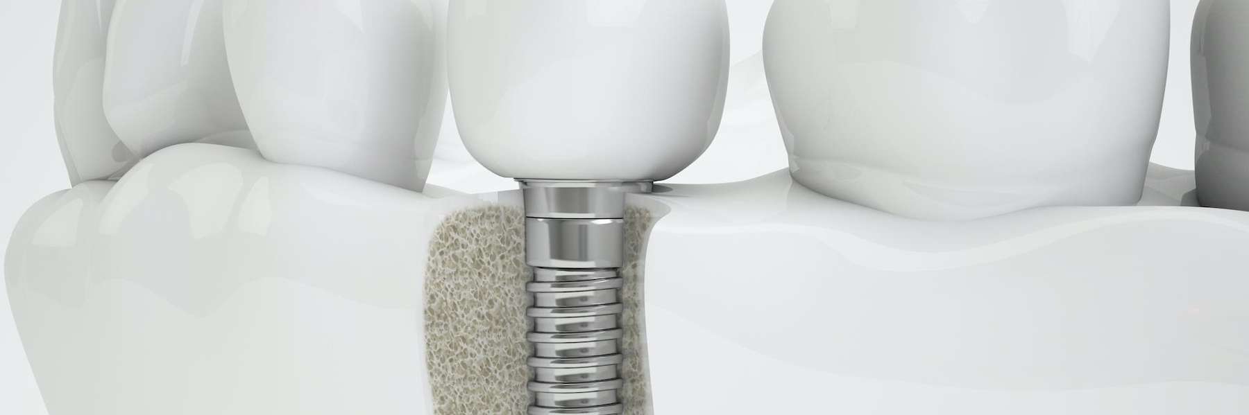 Dental implant single tooth example, fontana ca