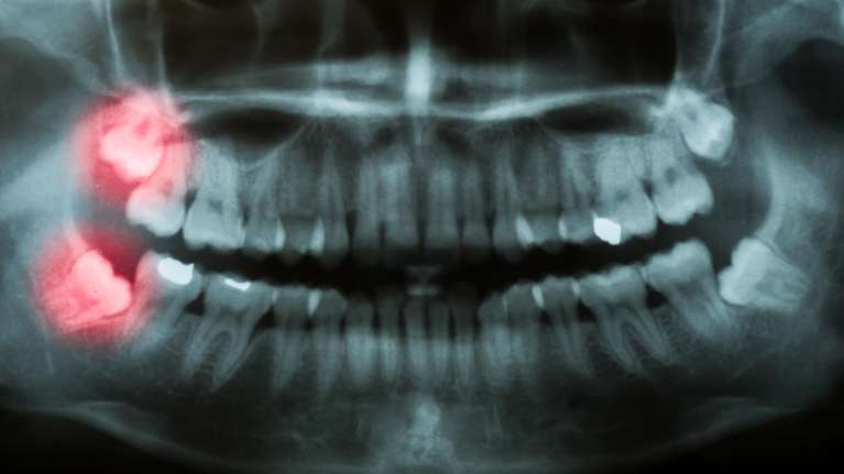 wisdom tooth x ray