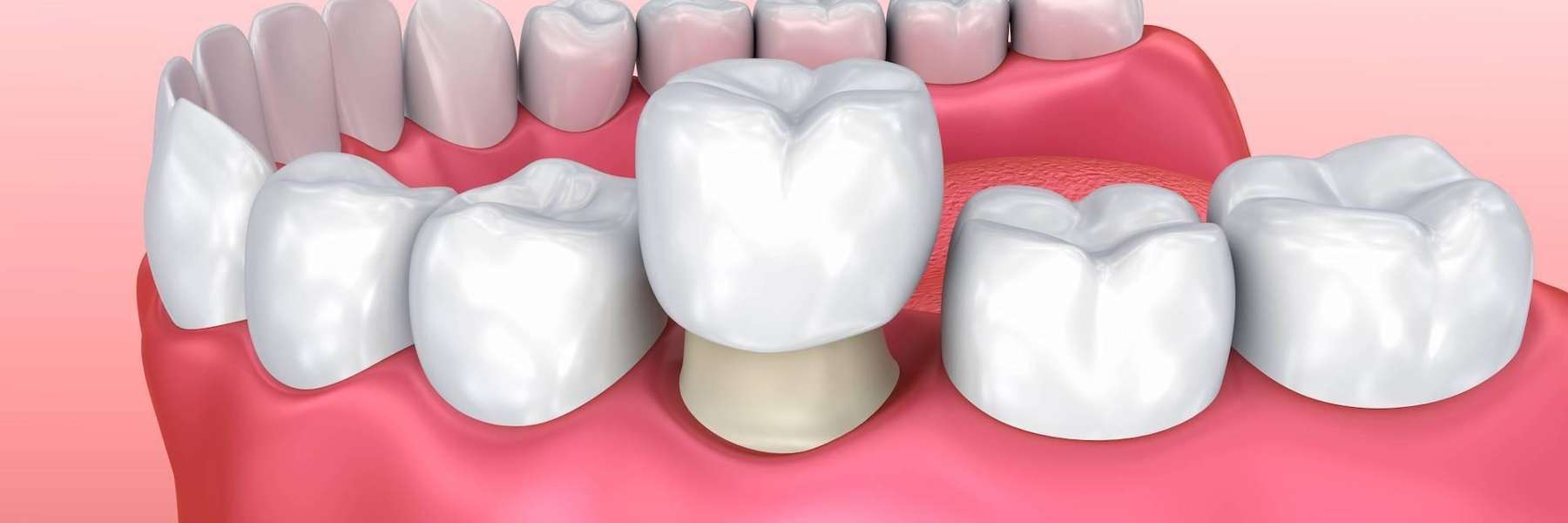 same day crowns fontana ca