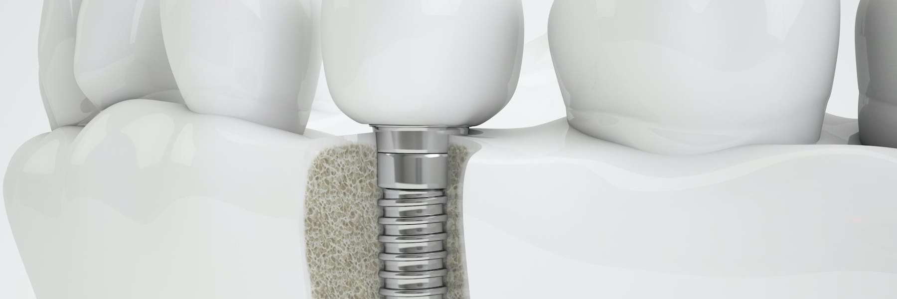 Image of dental implant, Fontana CA