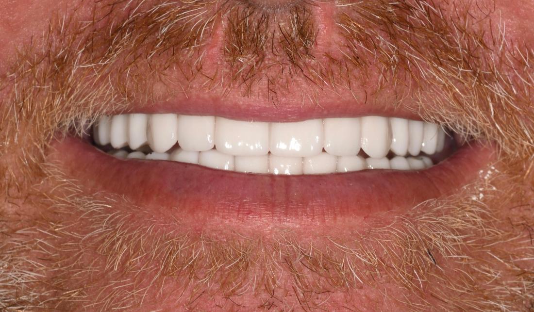 After Porcelain layered Zirconia Bridge in Winning Smiles Fontana CA