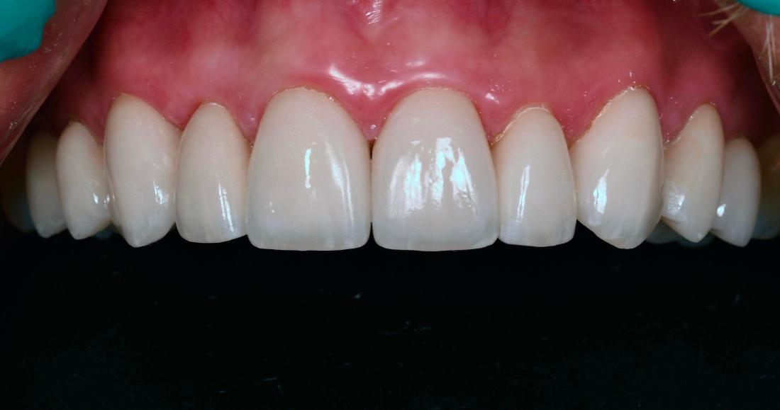 After Feldspathic Porcelain in Winning Smiles Fontana CA