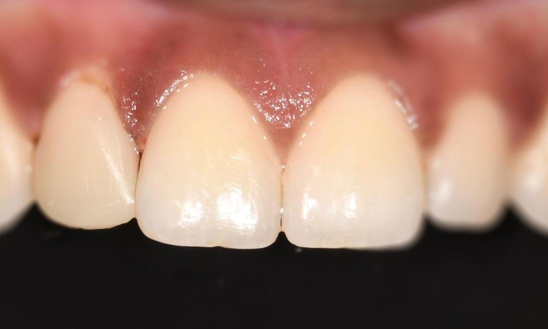 After Composite Veneer in Winning Smiles Fontana CA