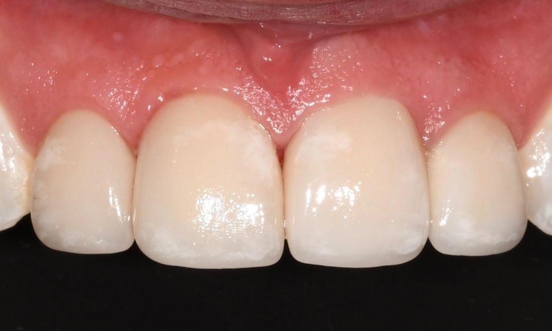 After Cosmetic Crowns & Veneers in Winning Smiles