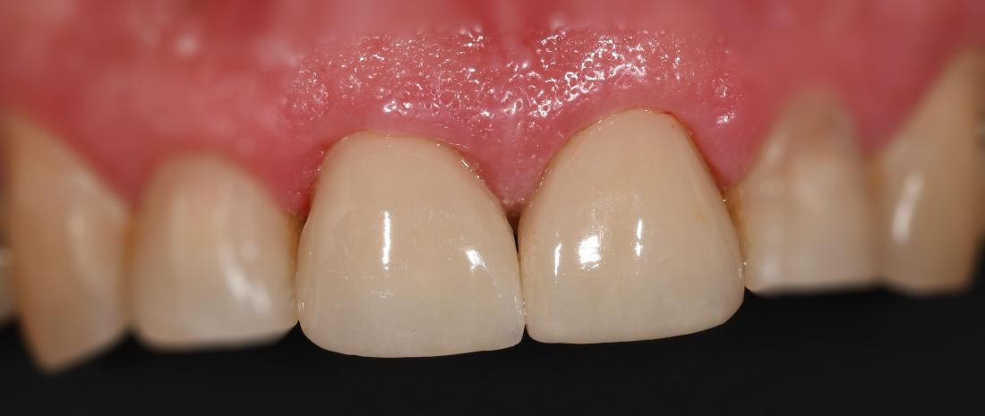 Dental Crowns in Fontana | After