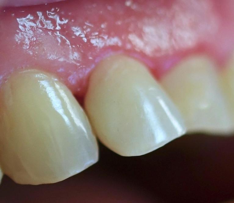 Tooth Restorations in Fontana | After