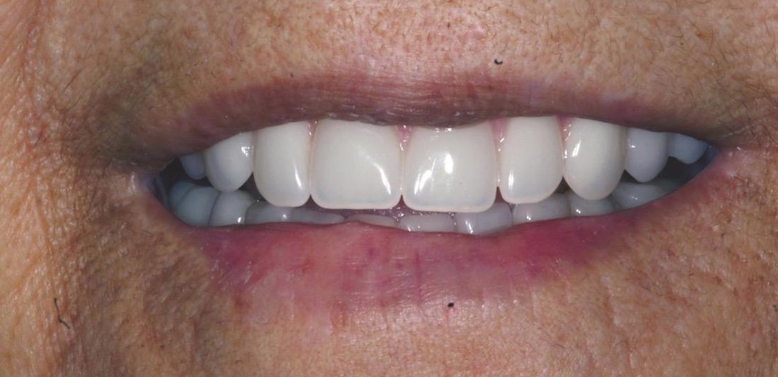Modern Dentures in Fontana | After