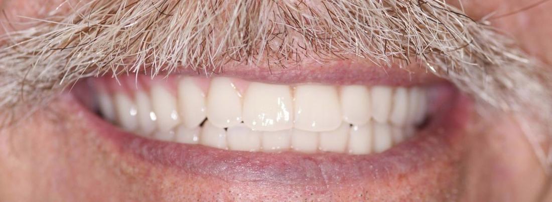 Modern Dentures in Fontana | After