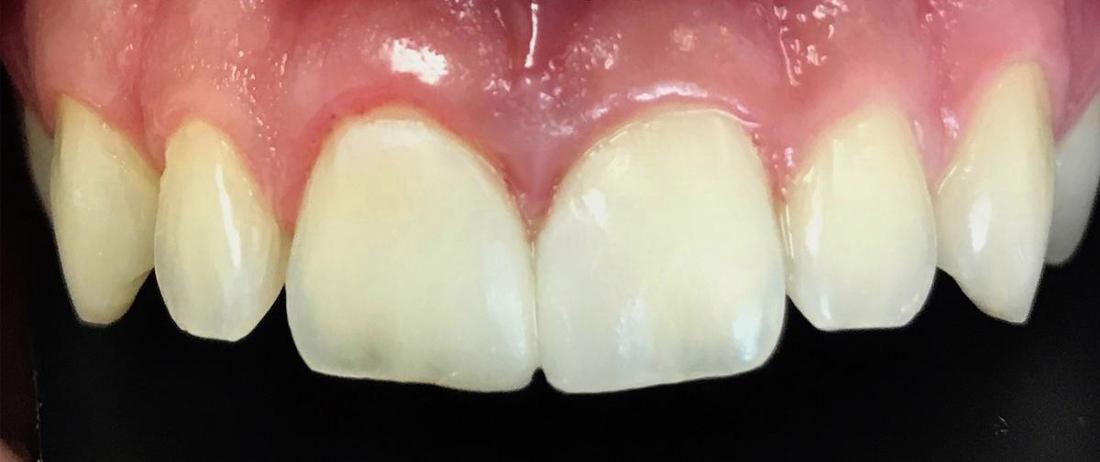 Tooth Repair in Fontana | After