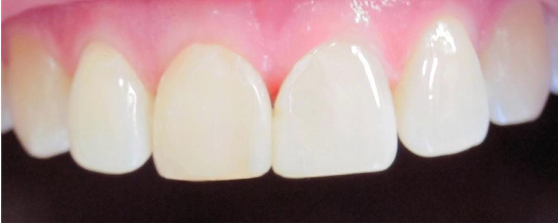 Tooth Repair in Fontana | After