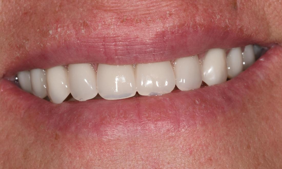 Full Mouth Rehab in Fontana | After