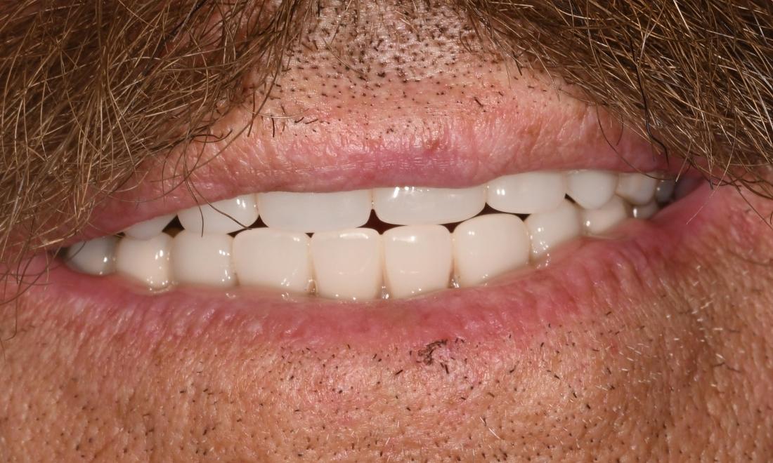 After Full Mouth Rehabilitation Same Day Treatment in Winning Smiles Fontana CA
