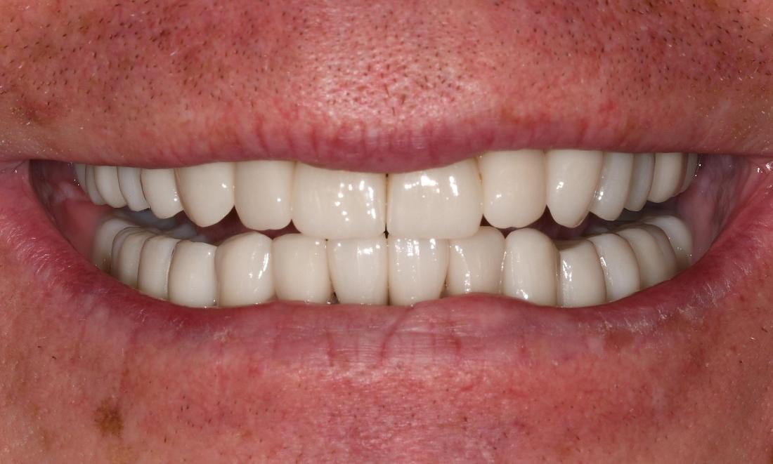 Full Mouth Rehab in Fontana | After