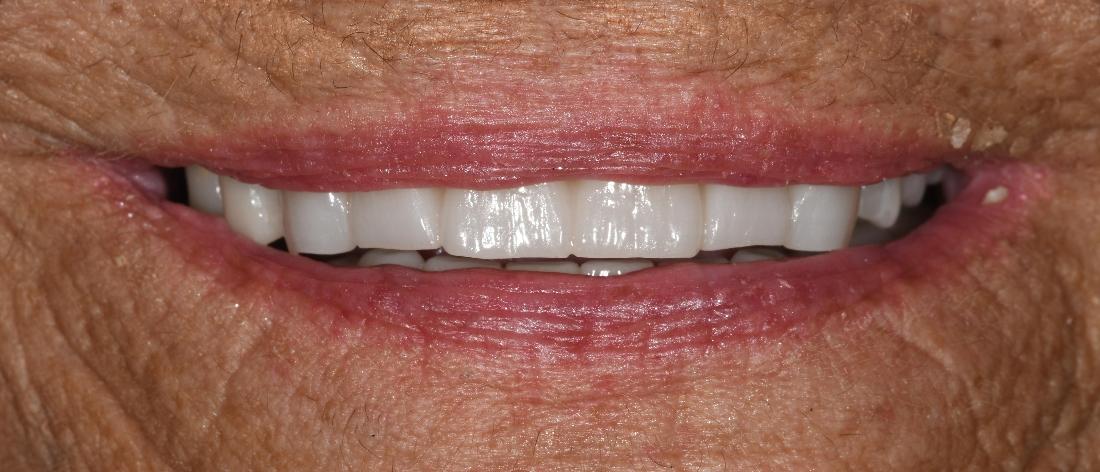 Smile Makeover in Fontana | After