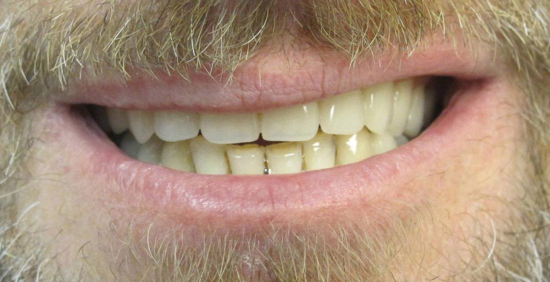 Full Mouth Rehab in Fontana | After
