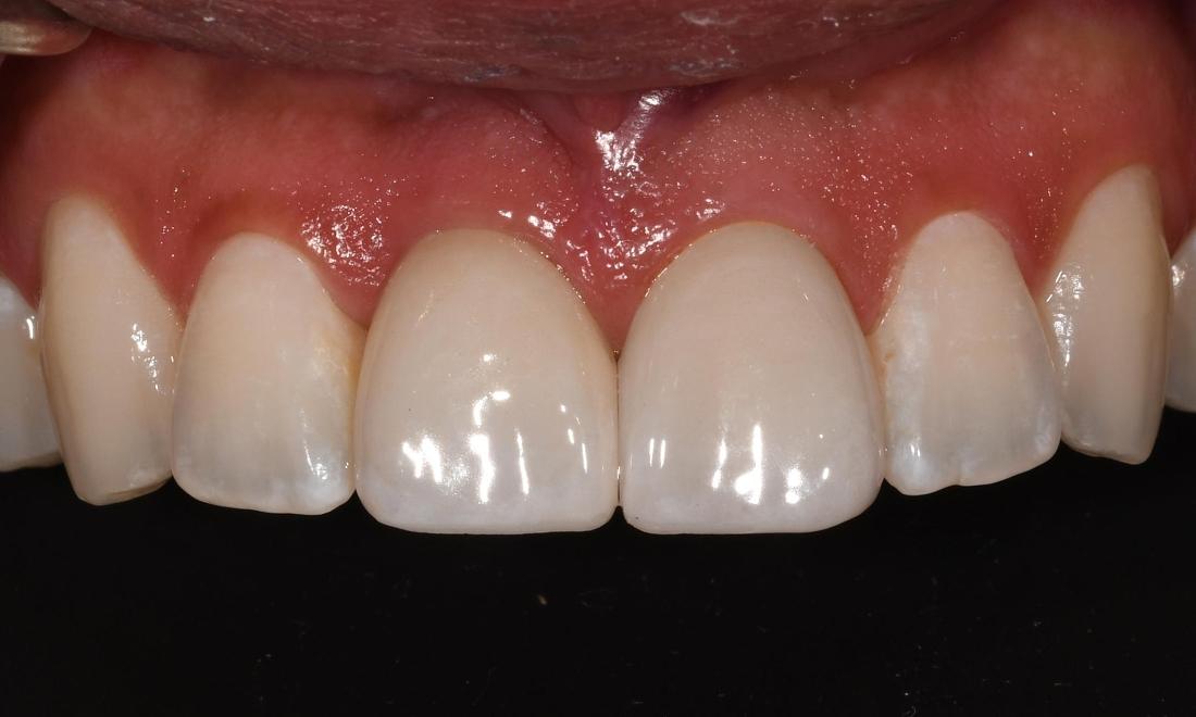 After Immediate Implant After Tooth Extraction in Fontana CA