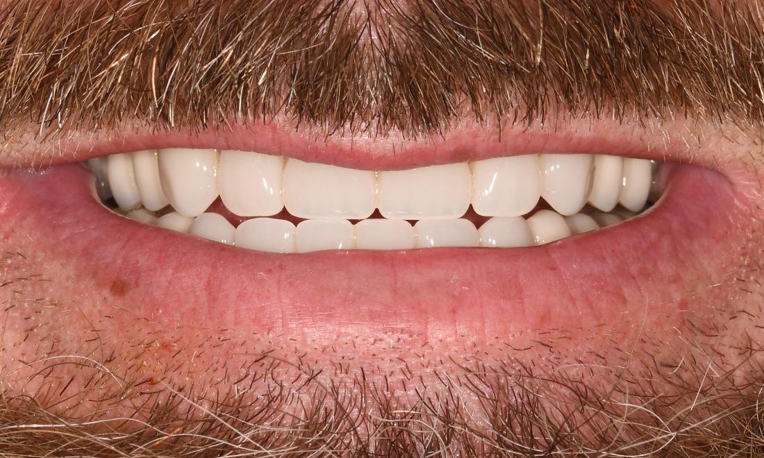 After Two Dental Implant in Winning Smiles Fontana CA