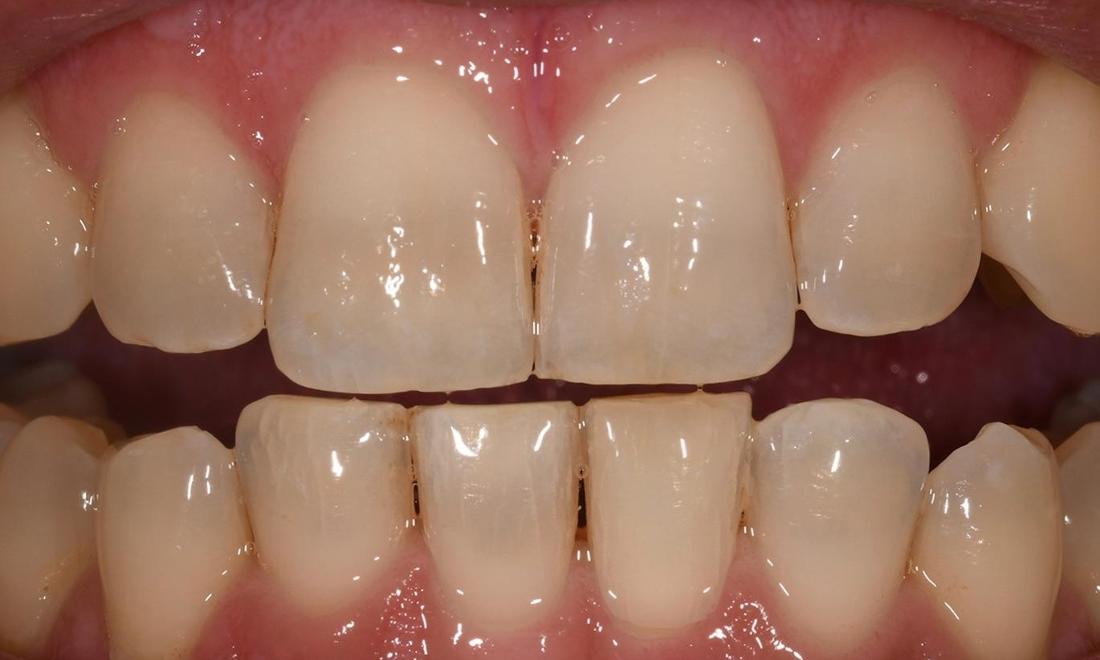 After Internal Bleaching in Fontana CA