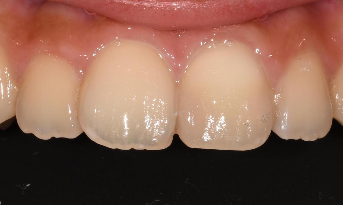 After Root Canal Therapy in Winning Smiles