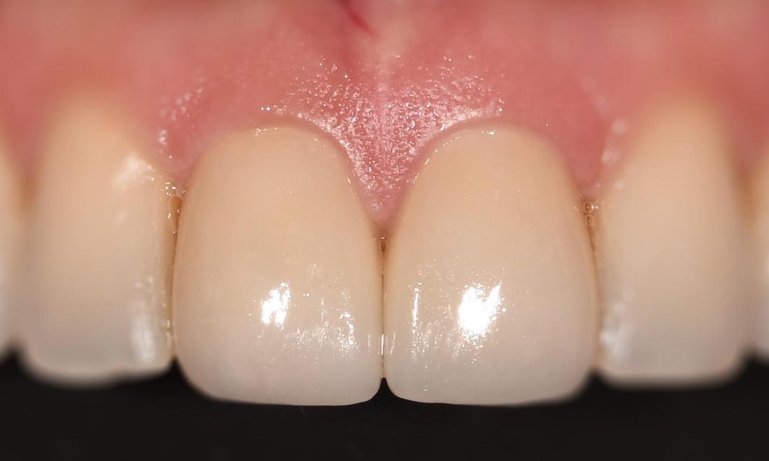 After Porcelain Veneer in Winning Smiles Fontana CA