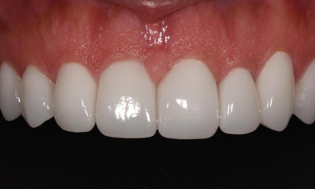 After Porcelain Crowns and Veneers in Winning Smiles Fontana CA