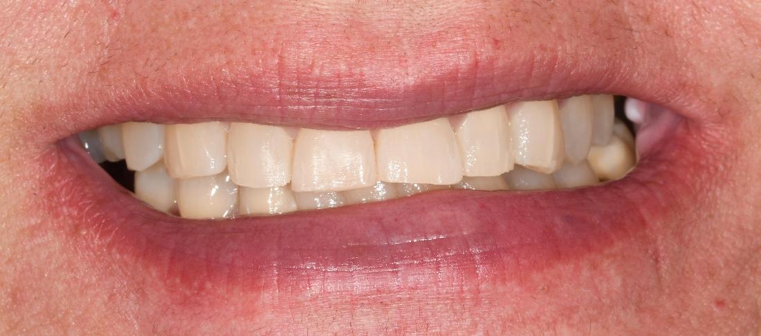 Adult Orthodontics in Fontana | After