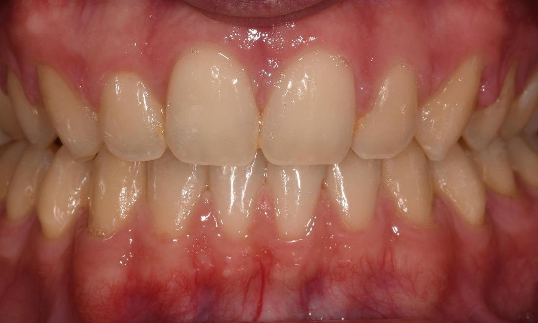 After Six Month Smiles in Winning Smiles Fontana CA