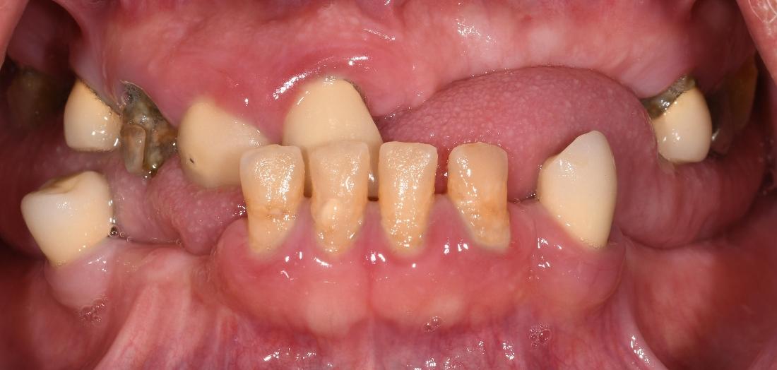 Before Porcelain layered Zirconia Bridge in Winning Smiles Fontana CA