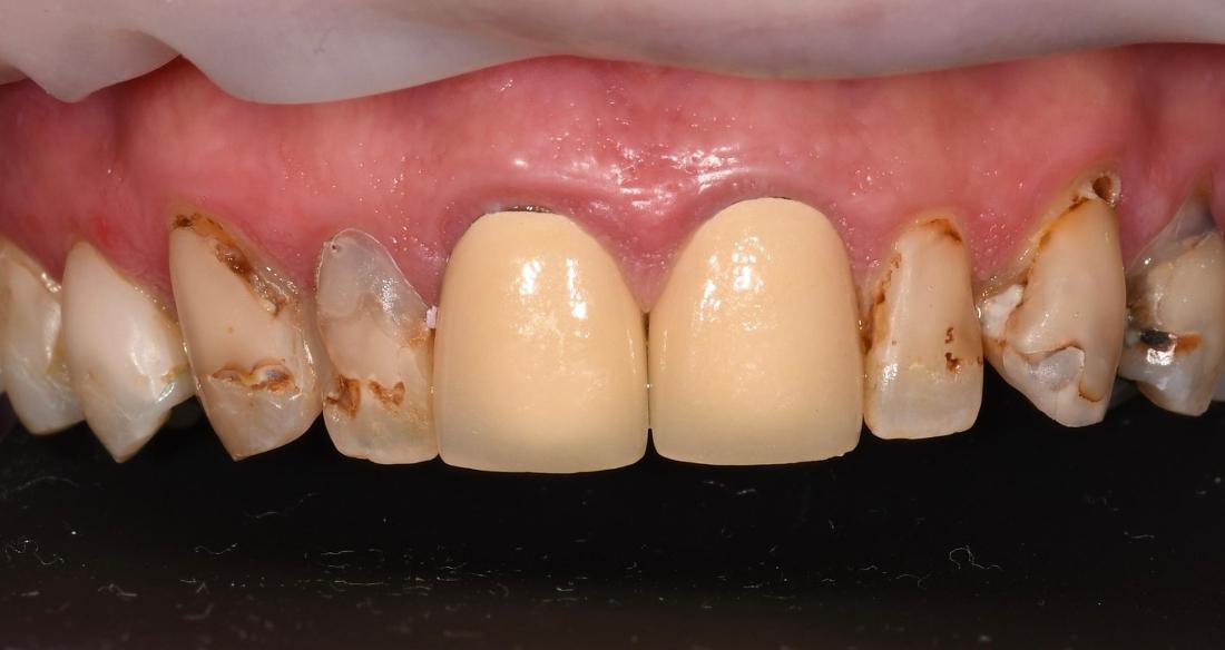 Before Feldspathic Porcelain in Winning Smiles Fontana CA