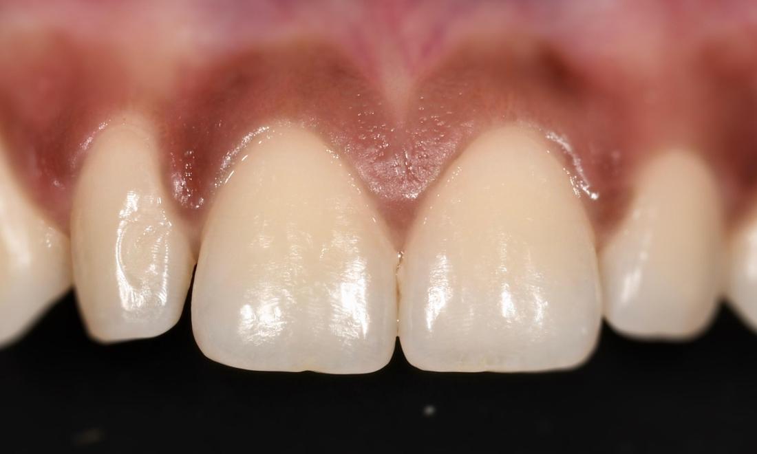 Before Composite Veneer in Winning Smiles Fontana CA