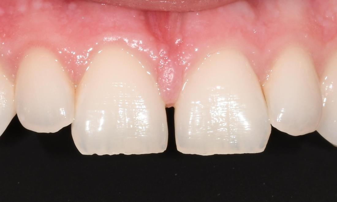 Before Bonding to Close Diastema Same Day Treatment in Winning Smiles Fontana CA
