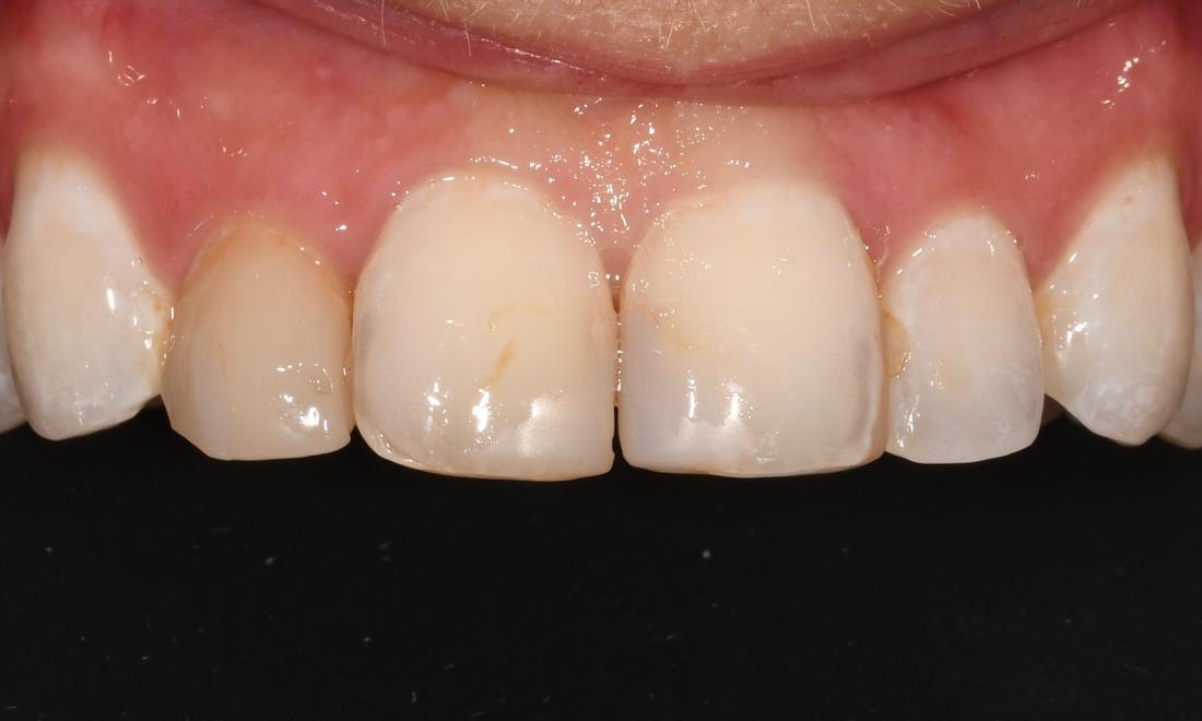 Before Cosmetic Crowns & Veneers in Winning Smiles
