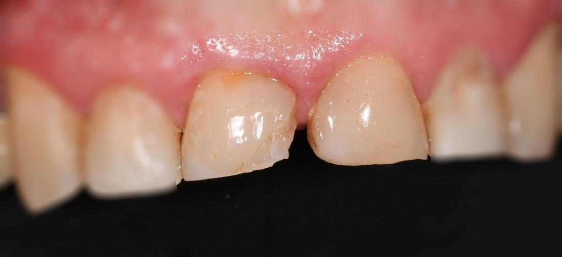Dental Crowns in Fontana | Before