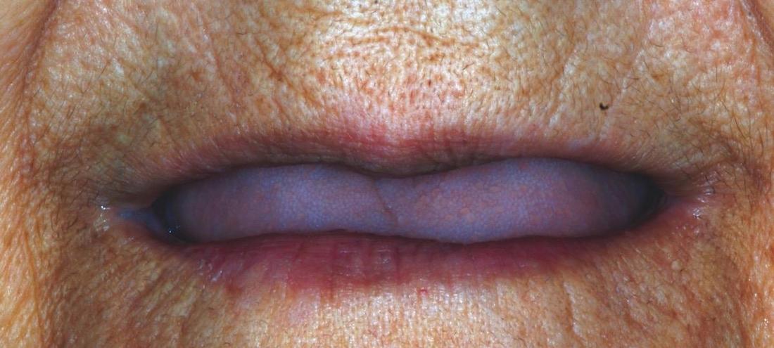 Modern Dentures in Fontana | Before