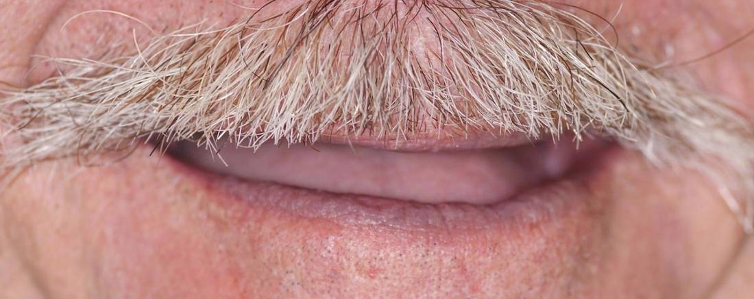 Modern Dentures in Fontana | Before