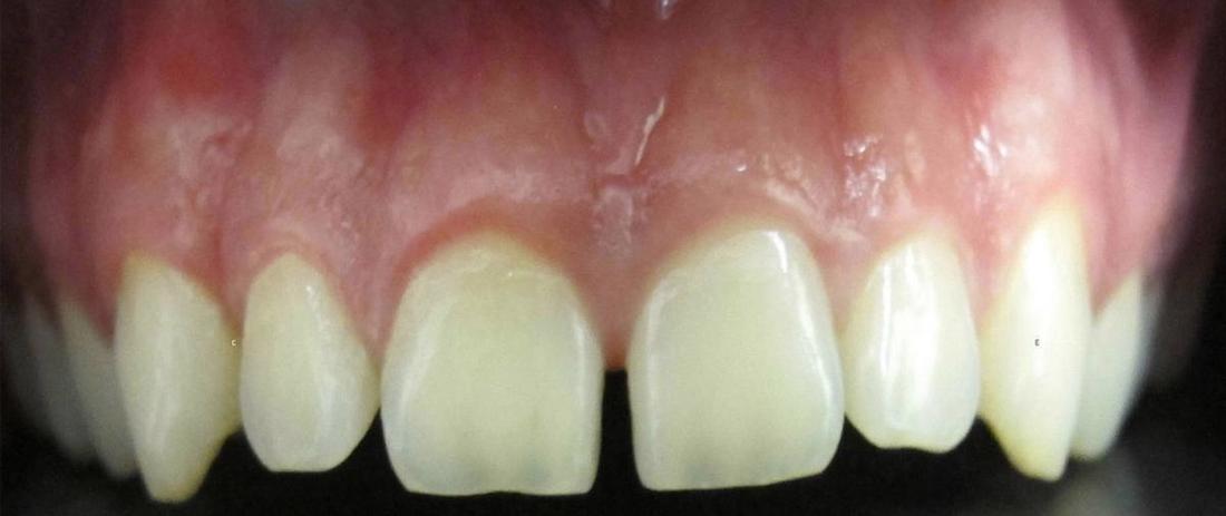 Tooth Repair in Fontana | Before