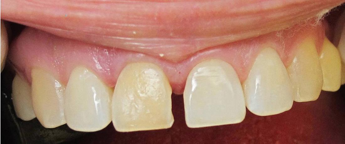 Tooth Repair in Fontana | Before