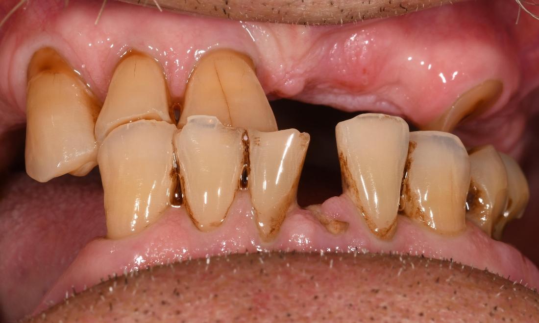 Before Full Mouth Rehabilitation Same Day Treatment in Winning Smiles Fontana CA