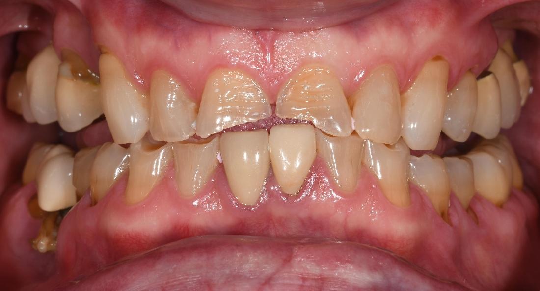 Full Mouth Rehab in Fontana | Before