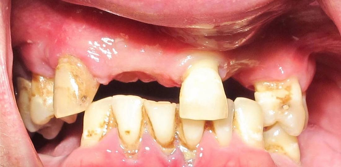 Full Mouth Rehab in Fontana | Before