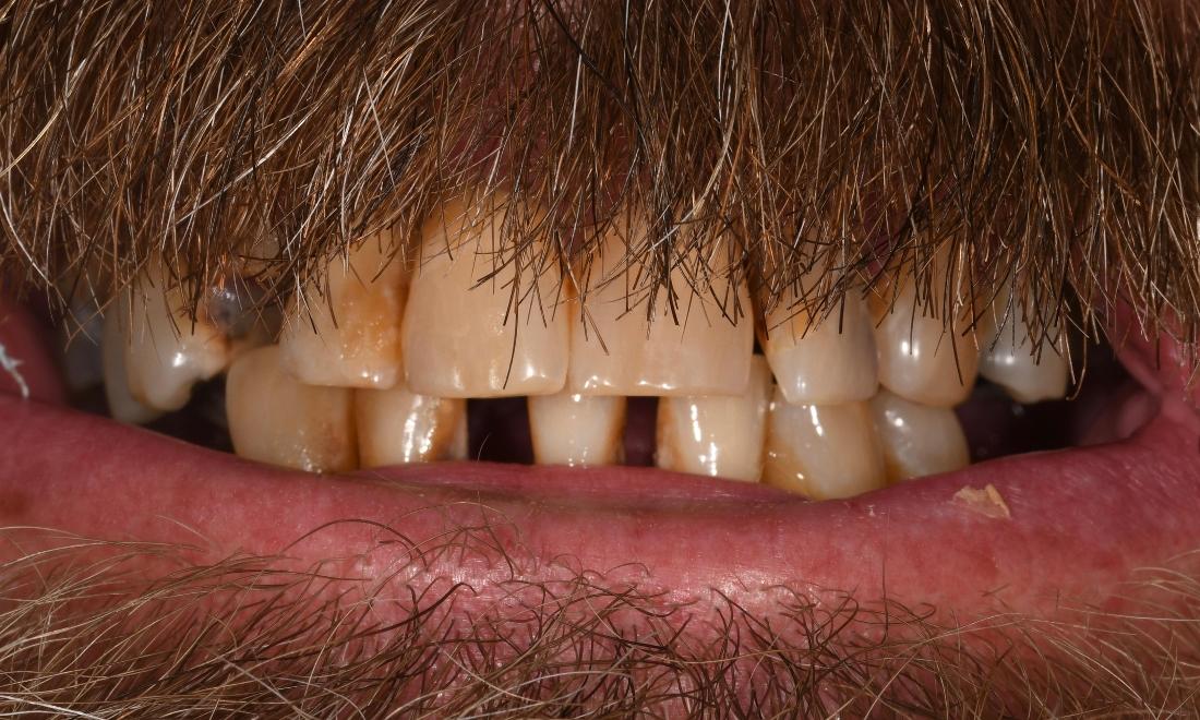 Before Two Dental Implant in Winning Smiles Fontana CA