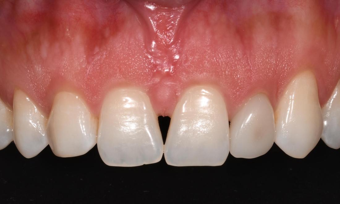 Before Porcelain Crowns and Veneers in Winning Smiles Fontana CA