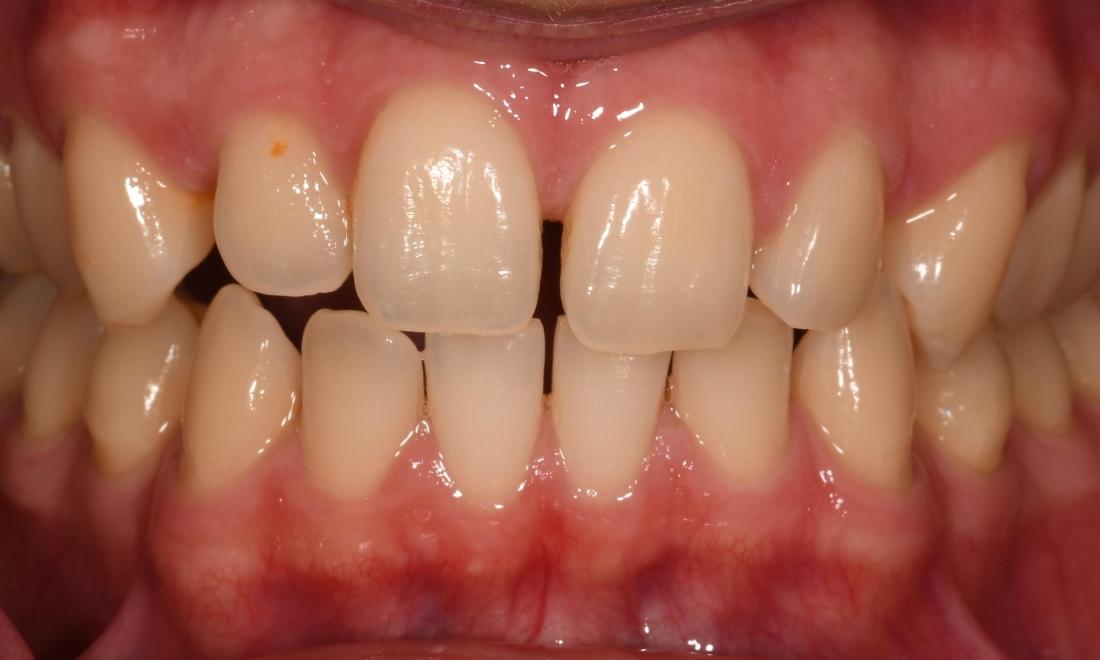 Before Six Month Smiles in Winning Smiles Fontana CA