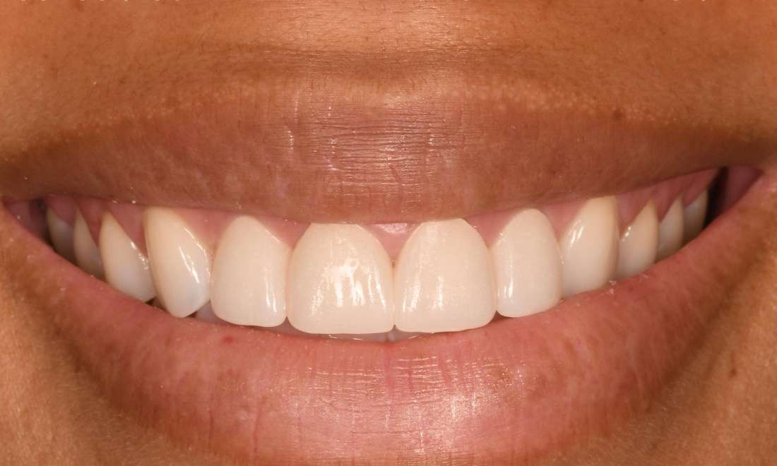 Close up of a smile after veneers, fontana ca