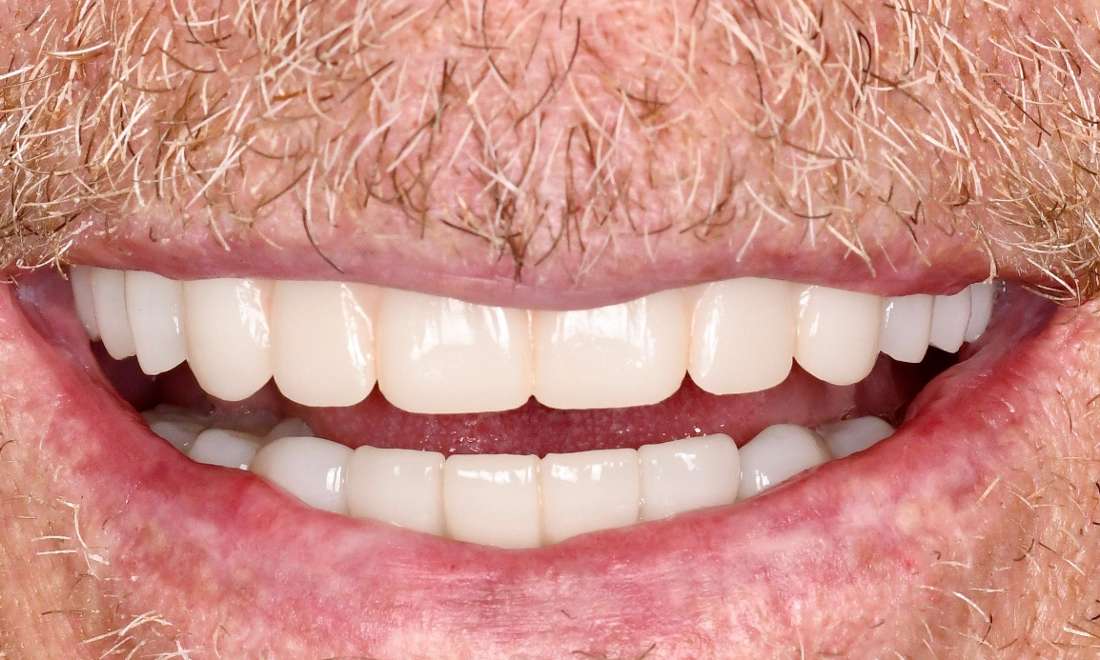 Mouth after all on x with crowns, fontana ca