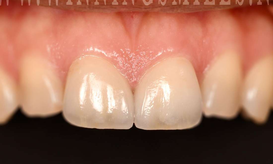 After veneers on chipped teeth, fontana ca