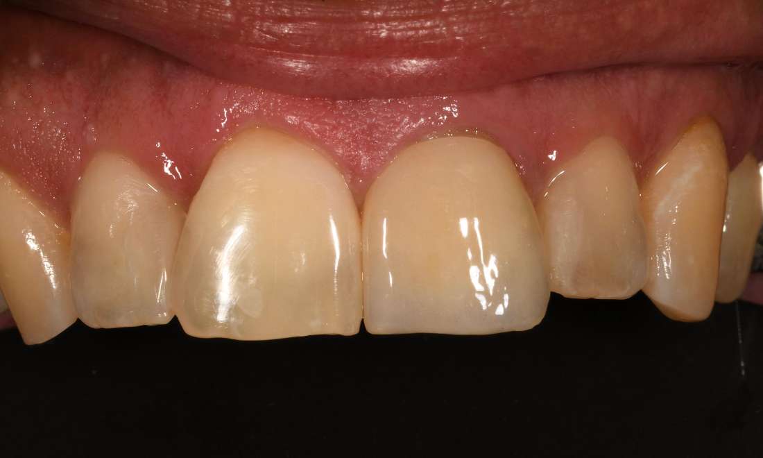 Close up of mouth after cosmetic crown and fillings, fontana ca