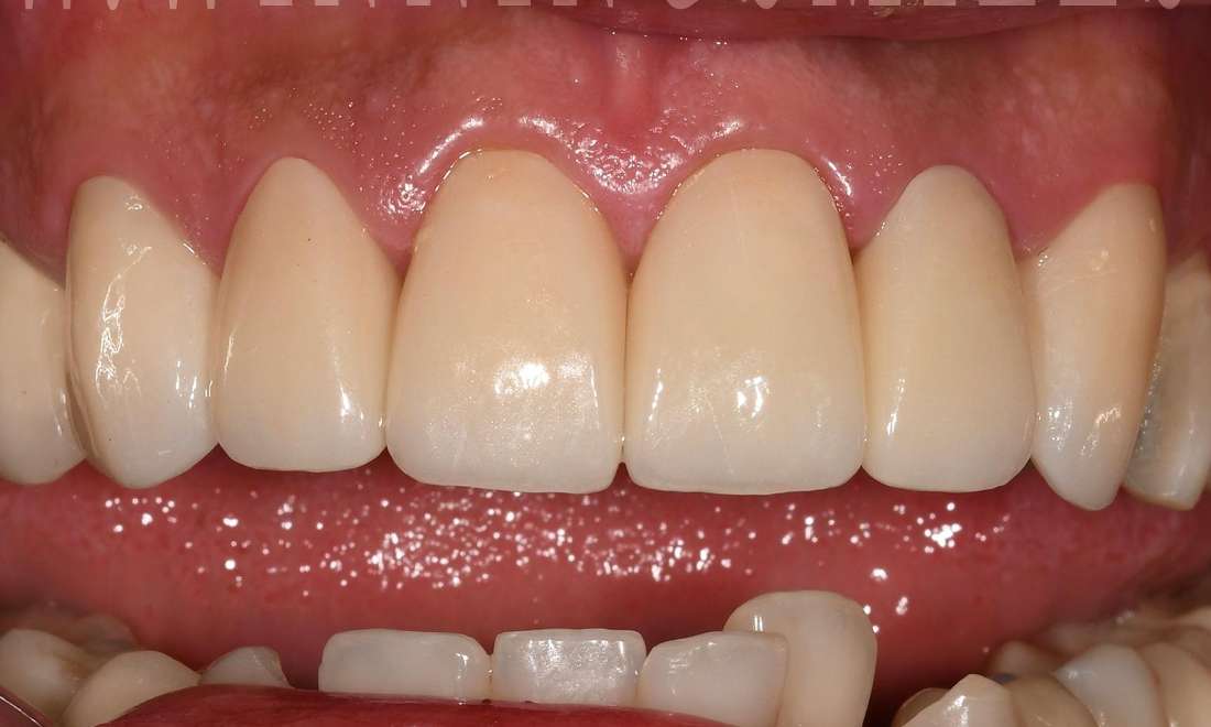 Close up of teeth after crowns and veeners, fontana ca