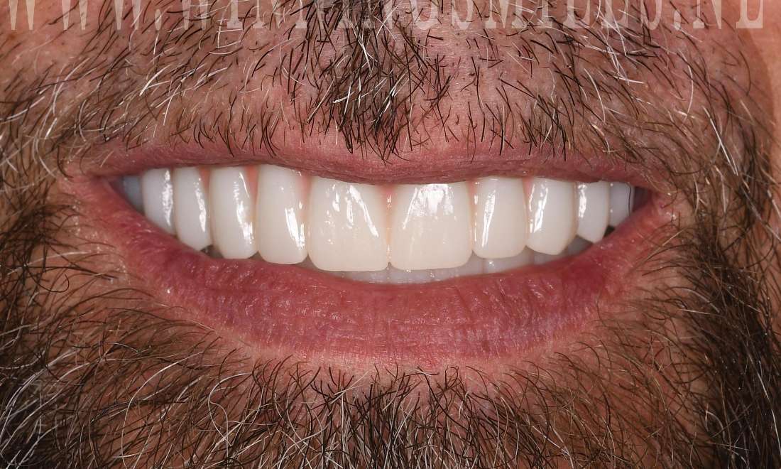 Mouth after full mouth rehabilitation, fontana ca